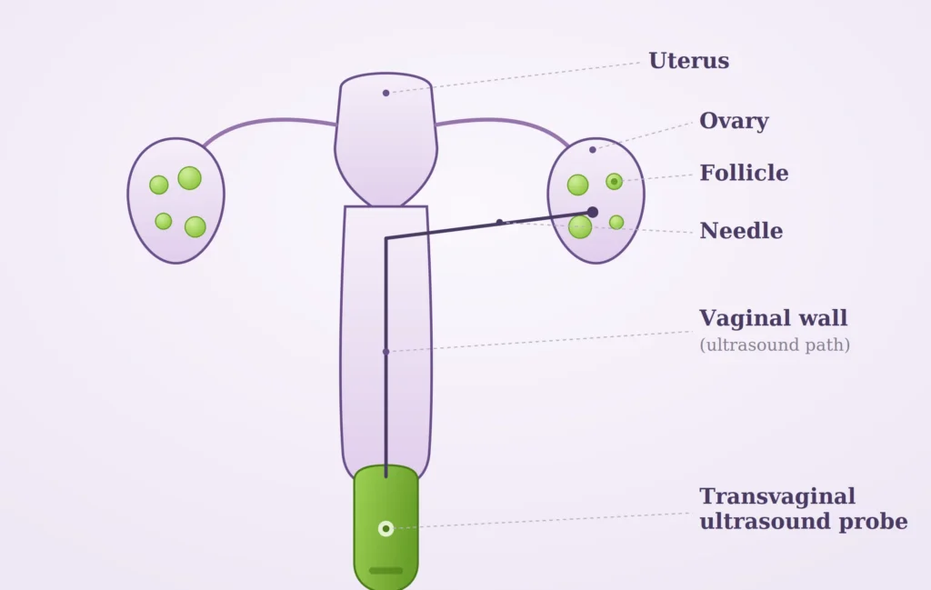IVF Egg Retrieval Process: Here is All You Need to Know